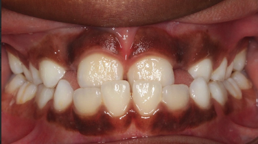 Phase I underbite – Patient 7 before