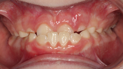 Phase I underbite – Patient 2 before