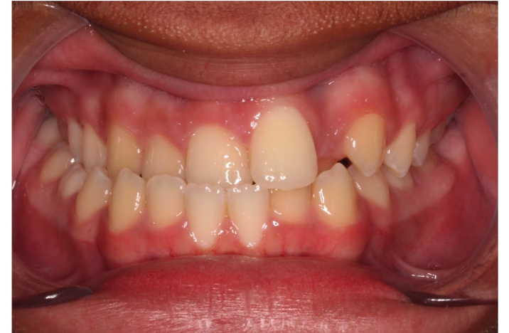 Comprehensive underbite – Patient 5 before