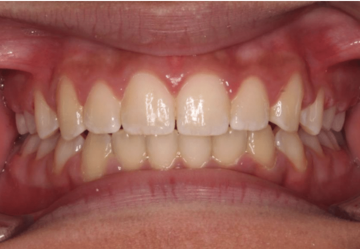 Comprehensive spacing – Patient 6 after