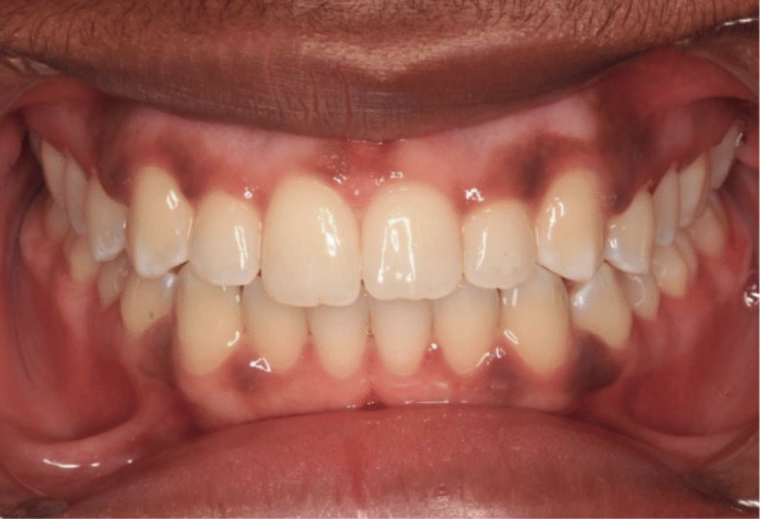 Comprehensive crowding – Patient 2 after