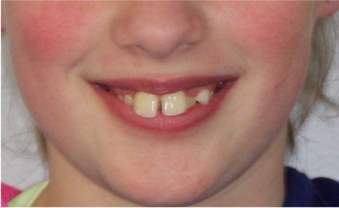 Comprehensive protrusion – Patient 2 before