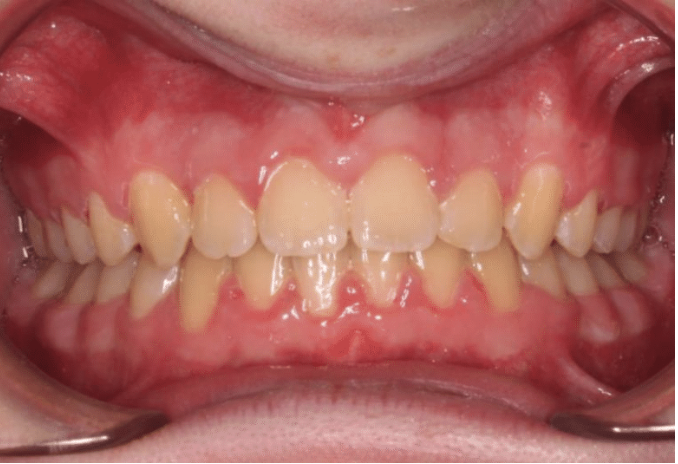 Comprehensive deep bite – Patient 3 after