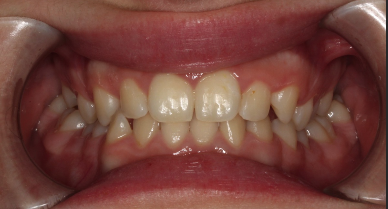 Phase I underbite – Patient 4 after
