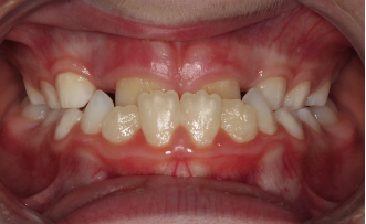 Phase I underbite – Patient 5 before