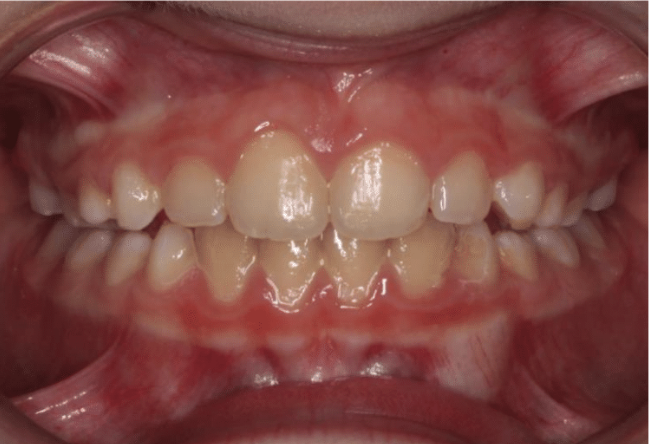 Digit habit – Patient 1 after