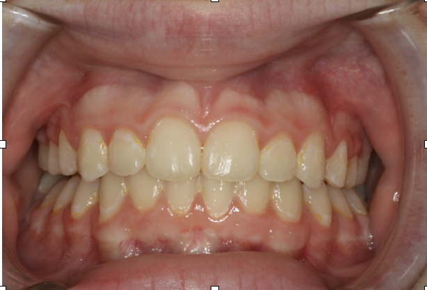 Crossbite correction – Patient 6 after