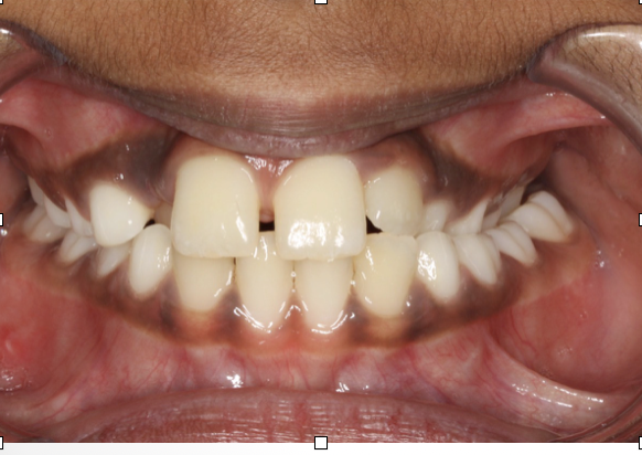 Crossbite correction – Patient 1 before