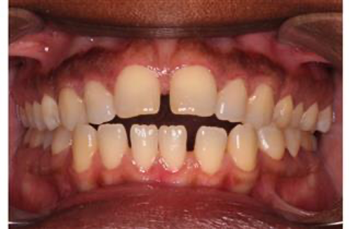 Comprehensive open bite – Patient 5 before