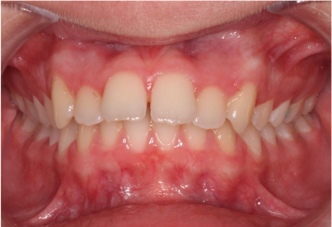 Comprehensive protrusion – Patient 5 before