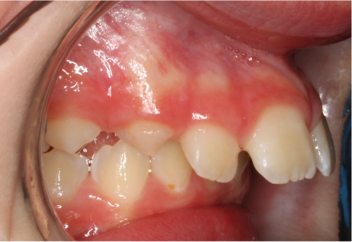 Comprehensive protrusion – Patient 4 before