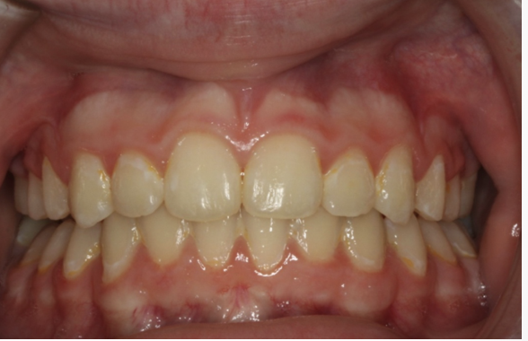 Crossbite correction – Patient 4 after