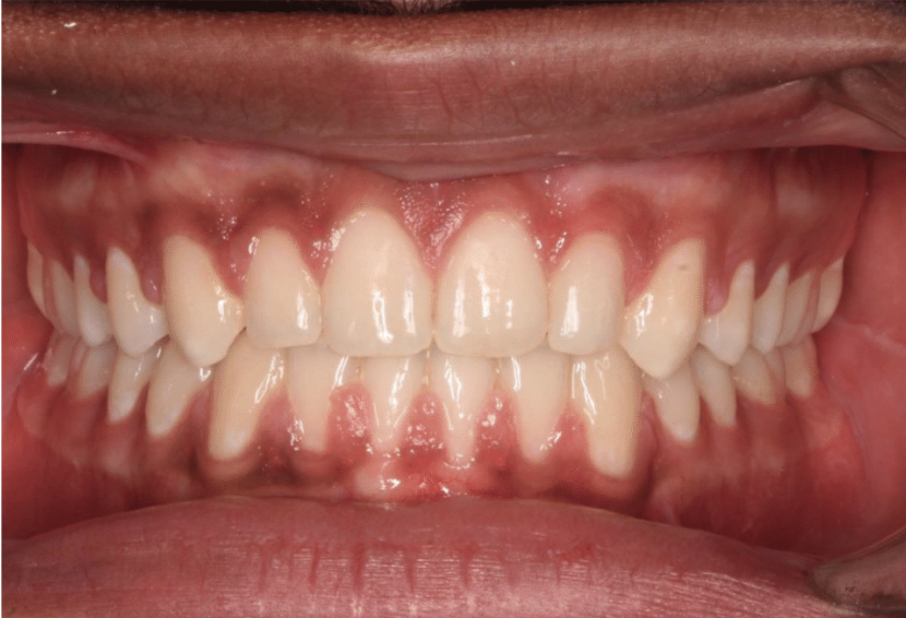 Comprehensive spacing – Patient 8 after