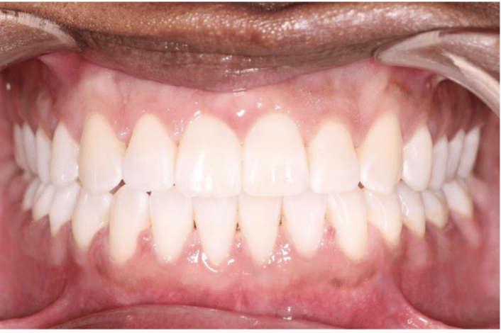 Comprehensive spacing – Patient 2 after