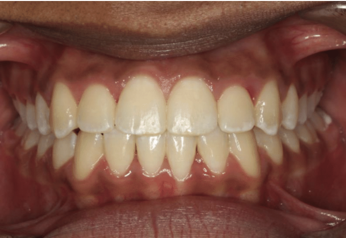 Comprehensive open bite – Patient 4 after