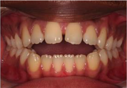 Comprehensive open bite – Patient 6 before