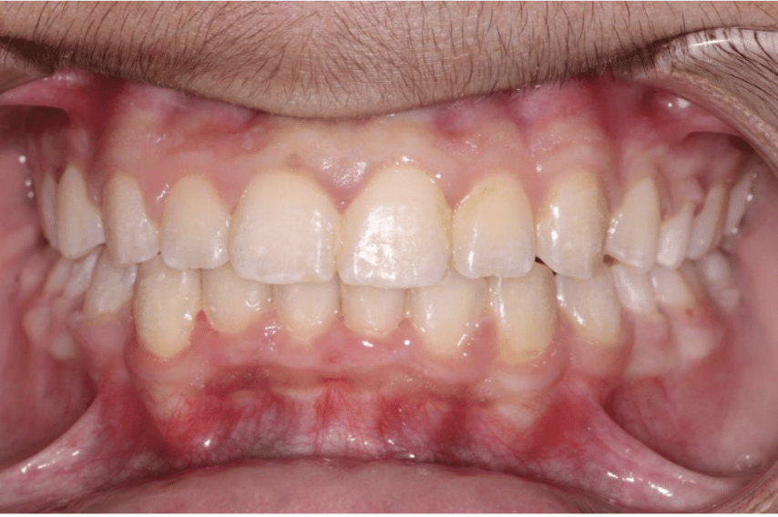 Comprehensive crowding – Patient 3 after