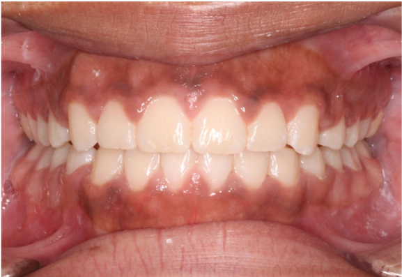 Comprehensive open bite – Patient 1 after