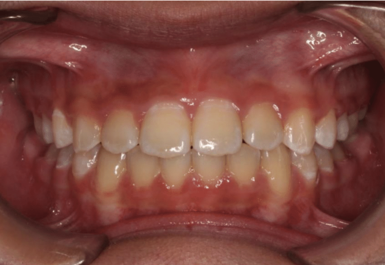 Comprehensive crowding – Patient 6 after