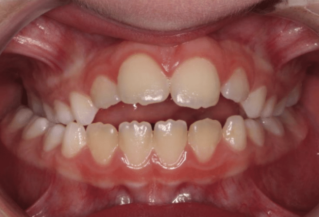 Digit habit – Patient 1 before