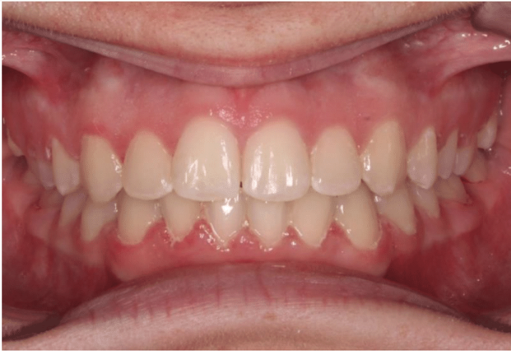 Comprehensive crowding – Patient 1 after
