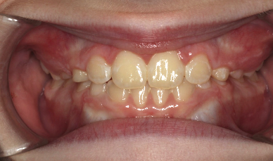 Phase I underbite – Patient 2 after