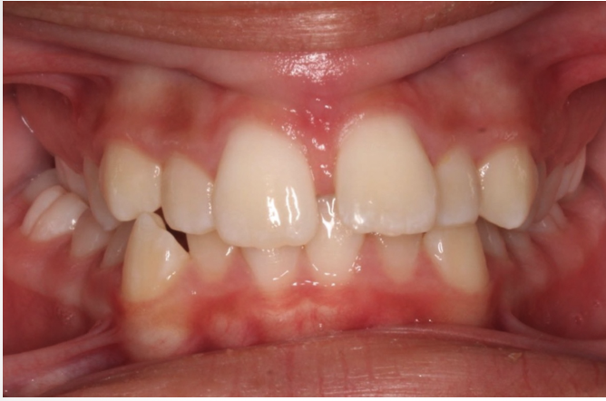 Crossbite correction – Patient 3 before