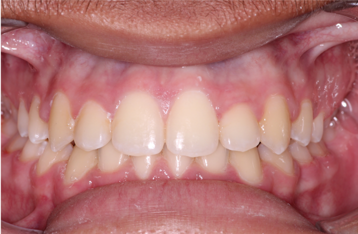 Comprehensive underbite – Patient 5 after