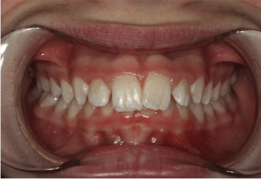 Comprehensive deep bite – Patient 8 before