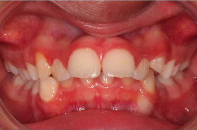 Comprehensive protrusion – Patient 8 before