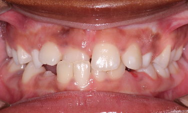 Phase I underbite – Patient 8 before