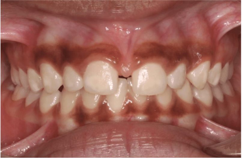Comprehensive spacing – Patient 3 before