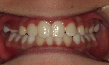 Phase I underbite – Patient 3 after
