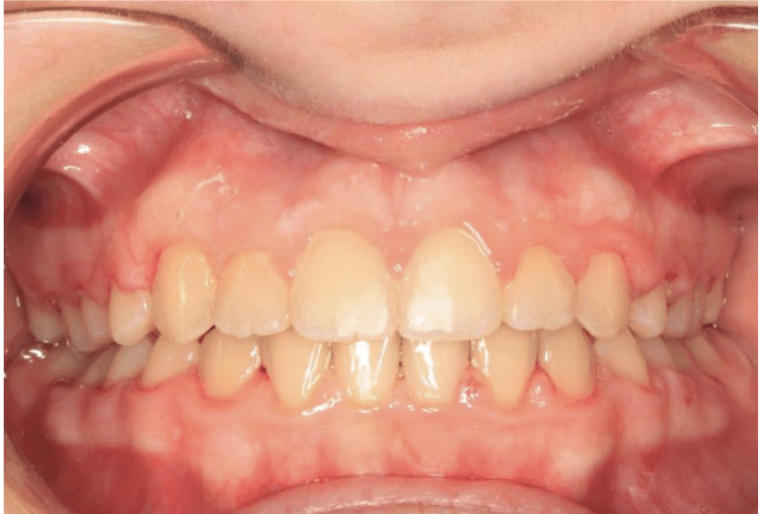 Digit habit – Patient 8 after