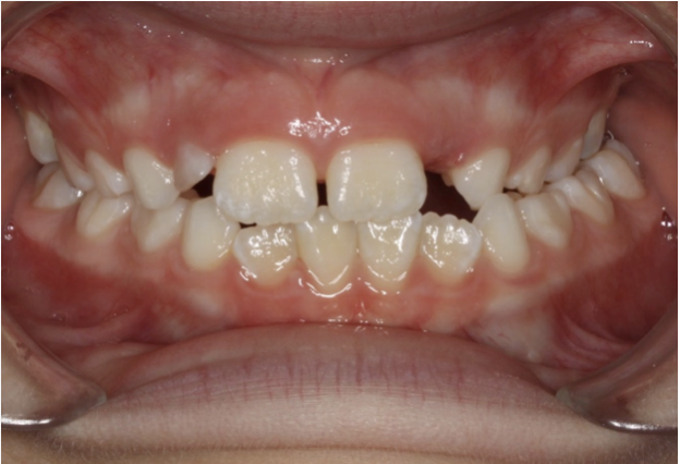 Crossbite correction – Patient 2 before