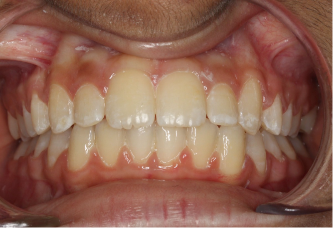 Comprehensive protrusion – Patient 1 after