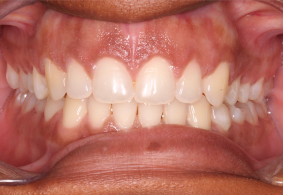 Comprehensive open bite – Patient 2 after