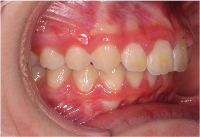 Comprehensive protrusion – Patient 4 after