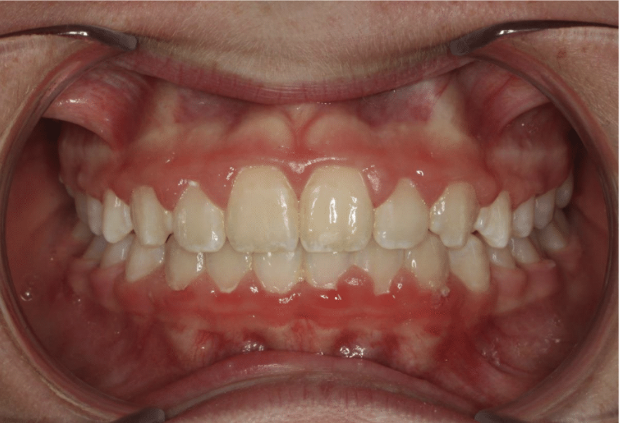 Comprehensive deep bite – Patient 8 after