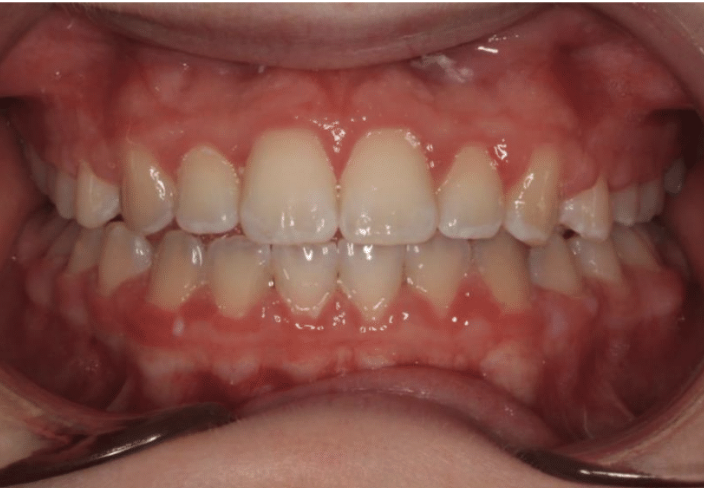 Digit habit – Patient 2 after
