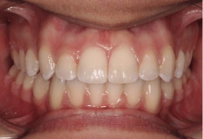 Comprehensive deep bite – Patient 4 after