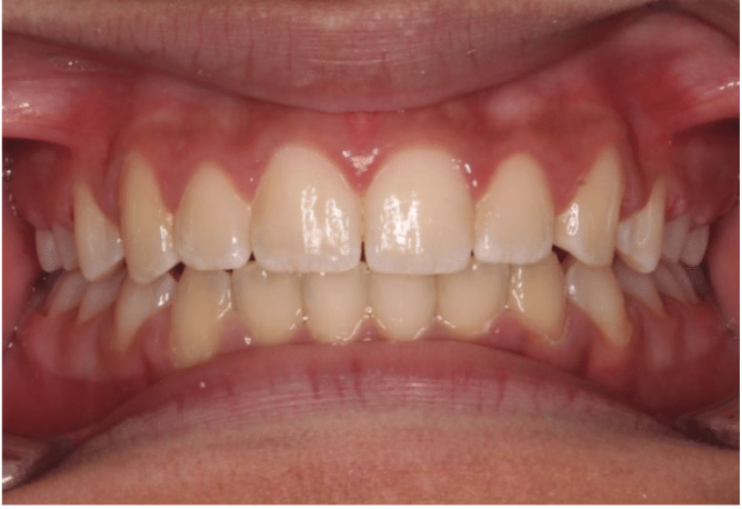 Comprehensive deep bite – Patient 1 after