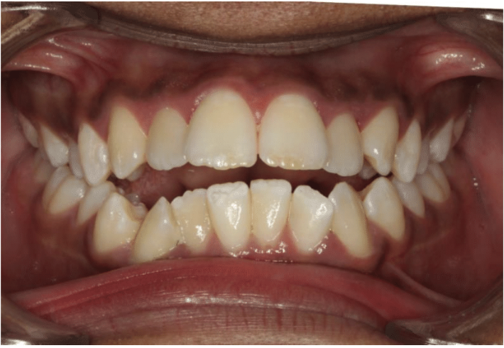 Comprehensive open bite – Patient 4 before