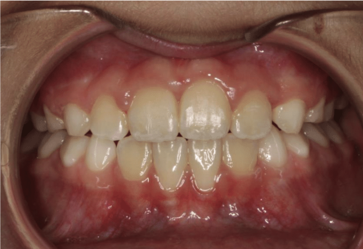 Digit habit – Patient 7 after