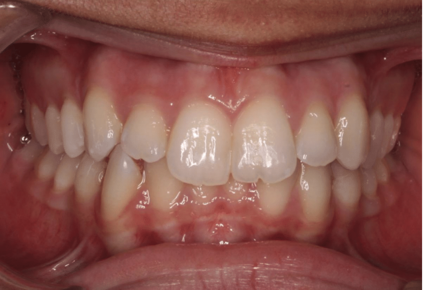 Comprehensive deep bite – Patient 4 before