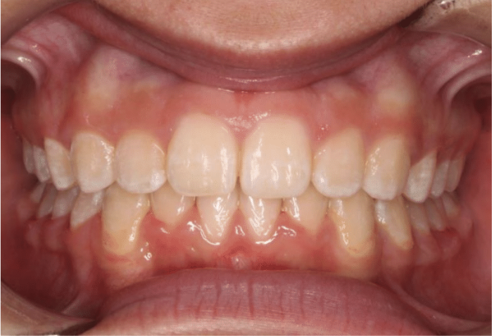 Comprehensive deep bite – Patient 5 after