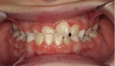Phase I underbite – Patient 4 before