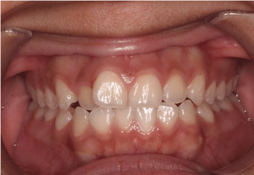 Comprehensive crowding – Patient 7 before