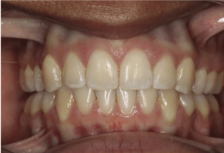 Comprehensive deep bite – Patient 7 after