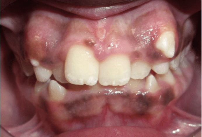 Comprehensive crowding – Patient 2 before